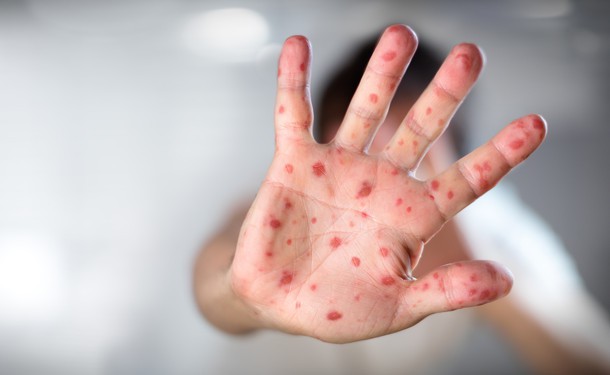 DrogMedia Кір у Дрогобичі: друга хвиля за цей рік!