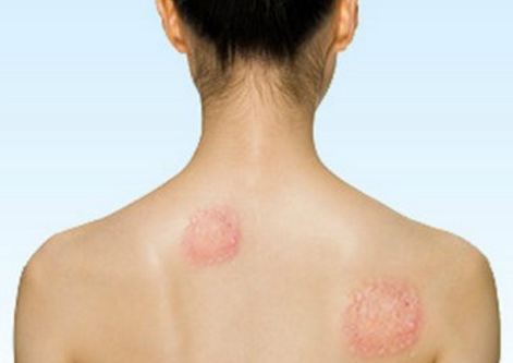 DrogMedia На Дрогобиччині зафіксували 4 випадки хвороби Лайма через укуси кліщів