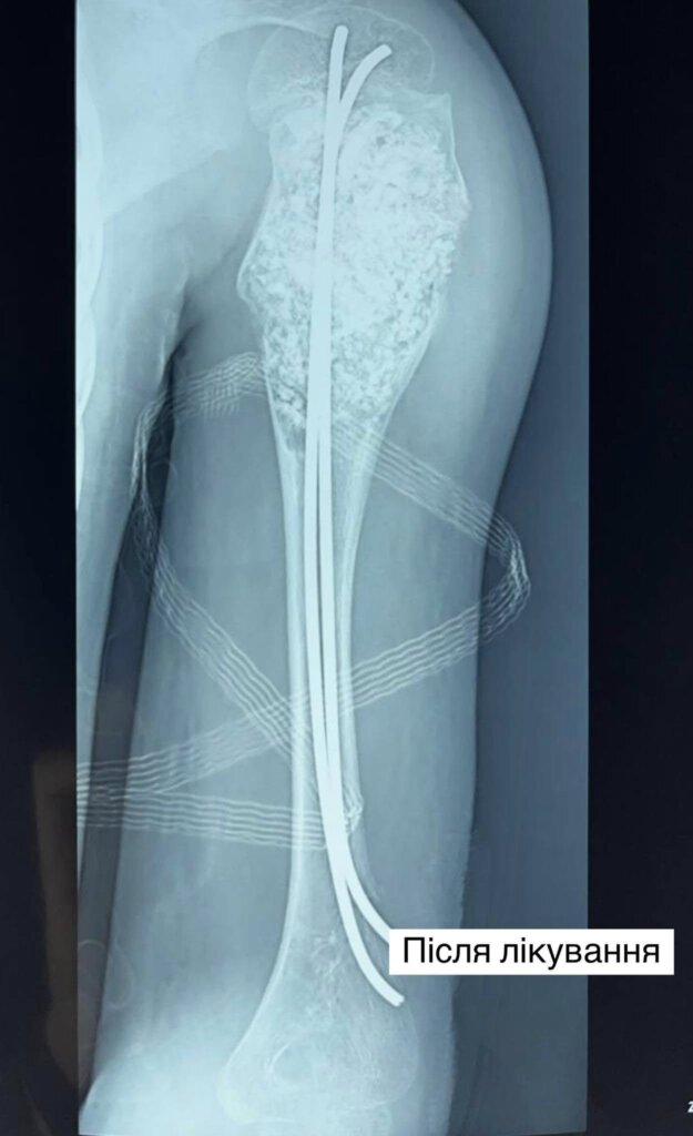 DrogMedia Повернули здорове дитинство - львівські лікарі провели унікальну операцію хлопчикові з Тернопільщини