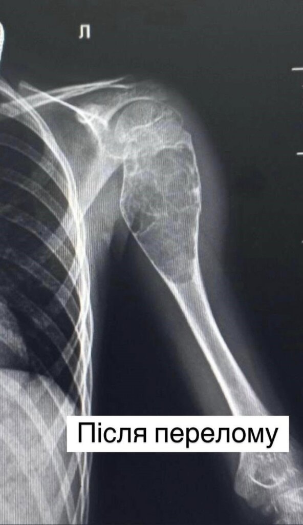 DrogMedia Повернули здорове дитинство - львівські лікарі провели унікальну операцію хлопчикові з Тернопільщини