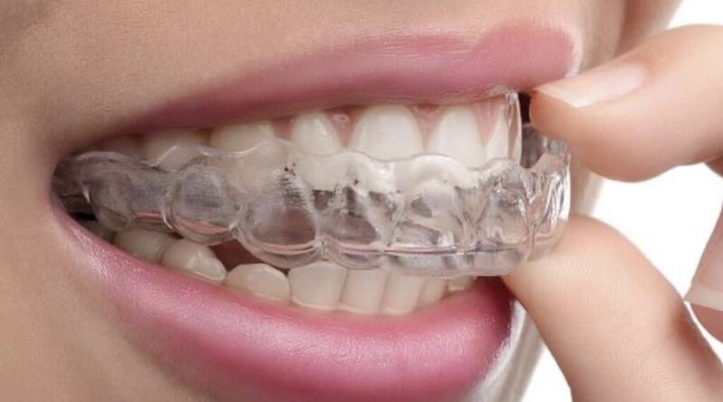 Елайнери у Львові: сучасний підхід до ідеальної усмішки