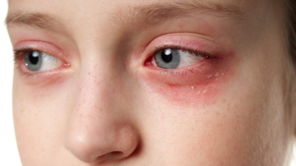 Ефективне лікування себорейного дерматиту на обличчі 1 Ефективне лікування себорейного дерматиту на обличчі