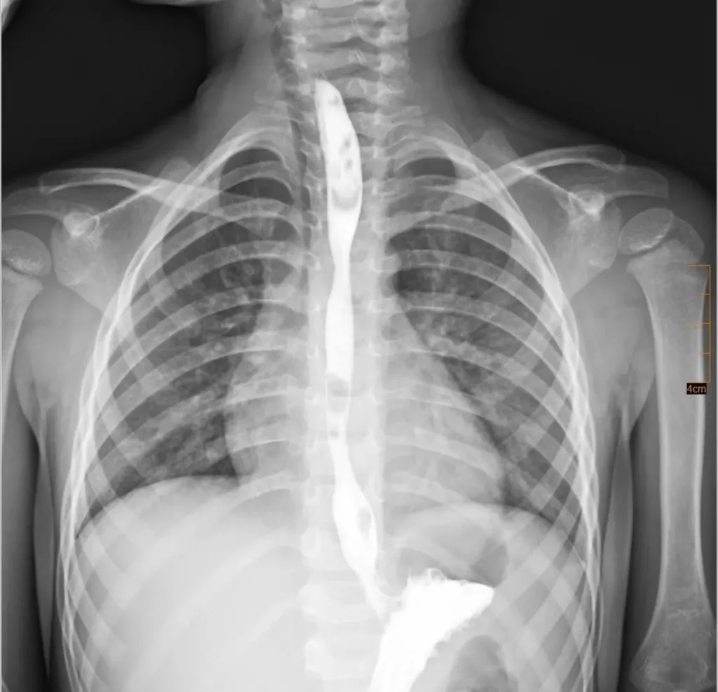 Випив антижир: львівські медики врятували дитину після тяжкого опіку стравоходу 2 Випив антижир: львівські медики врятували дитину після тяжкого опіку стравоходу